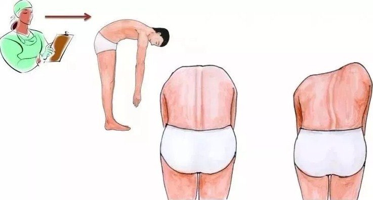 脊柱側(cè)彎早發(fā)現(xiàn)，早治療